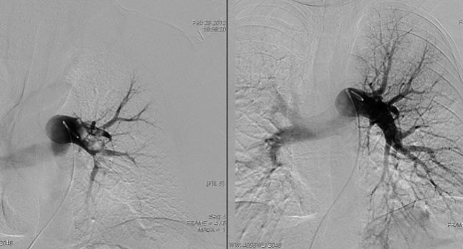 Hints of Benefit With Catheter-Directed Thrombolysis in Intermediate/High-Risk PE